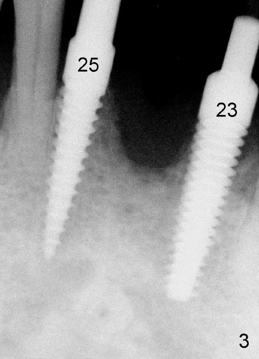 Immediate Implantsupported Bridge, Duluth, GA Dentist Dental Education